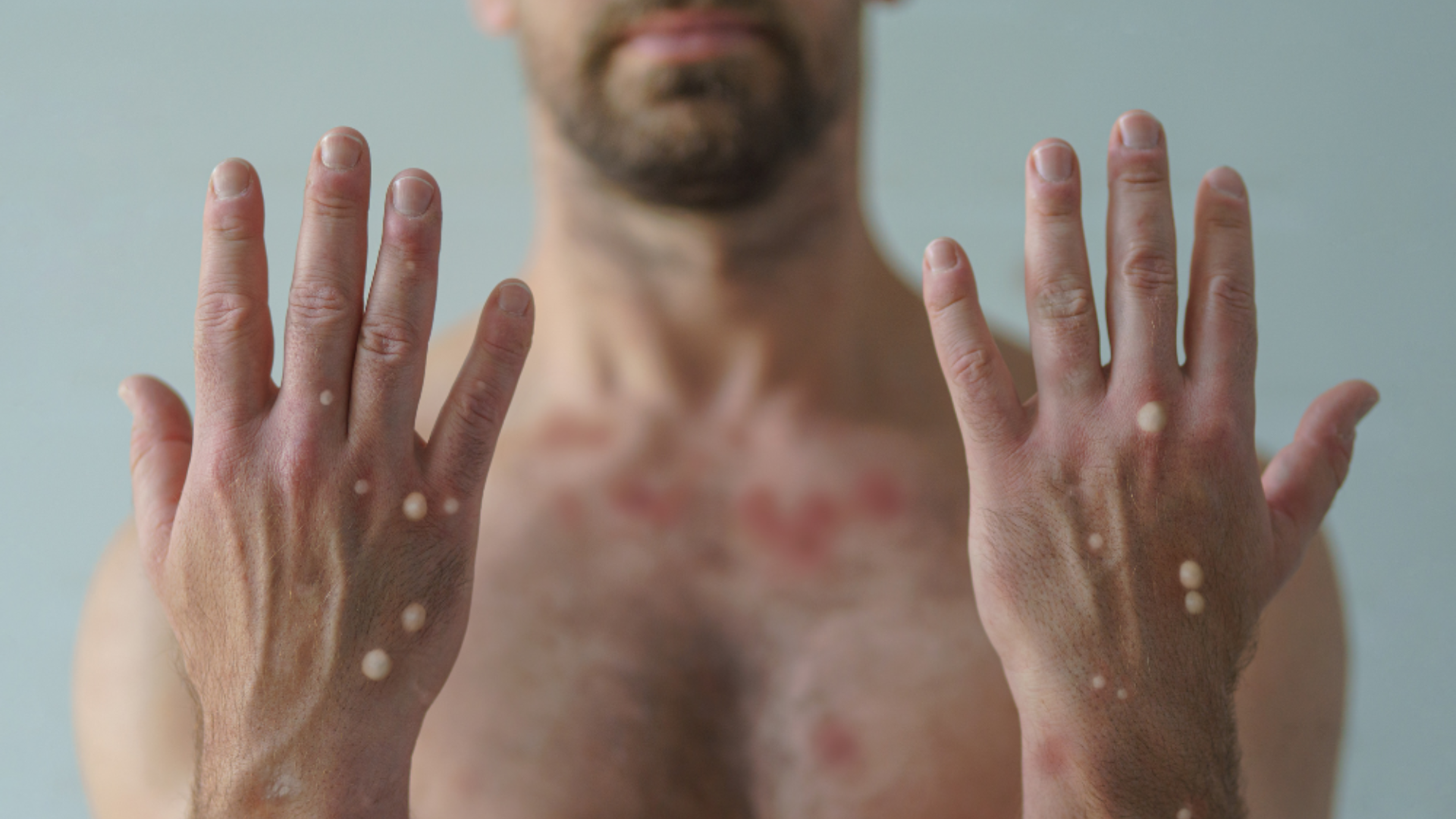 Casos de mpox mais que dobram em 20 dias, com 129 confirmações no Brasil